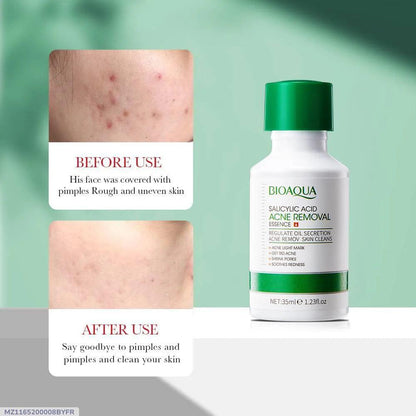 Salicylic Acid Acne Serum 35ml Clear Liquid